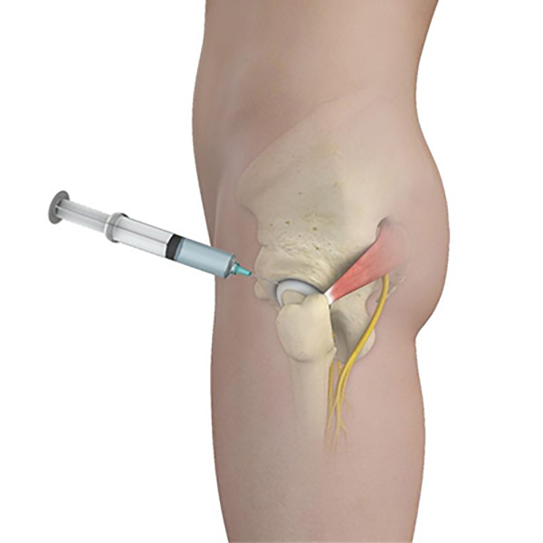 Bone Marrow Aspirate Concentrate (BMAC) 1 - Educational Picture